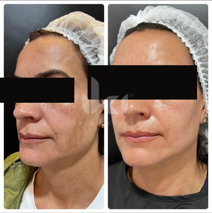 Antes y después de facial médico · hydrafacial en IKI Skin Experts, caso 7, identidad protegida