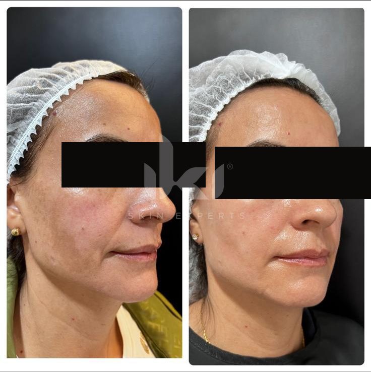 Antes y después de facial médico · hydrafacial en IKI Skin Experts, caso 8, identidad protegida