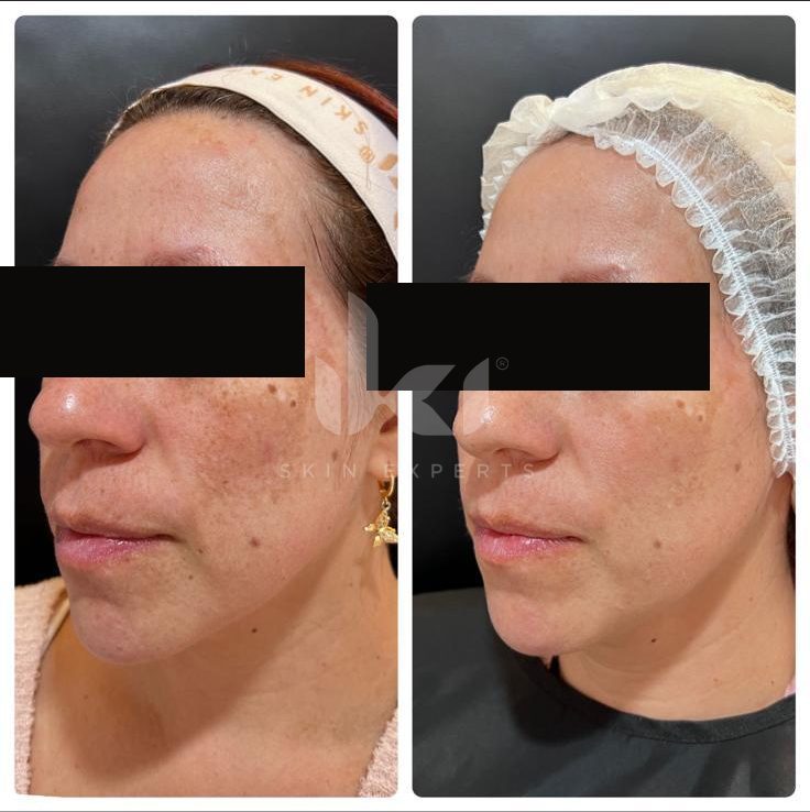 Antes y después de manchas y melasma en IKI Skin Experts, caso 24, identidad protegida