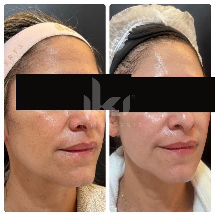 Antes y después de hifu · flacidez en IKI Skin Experts, caso 5, identidad protegida