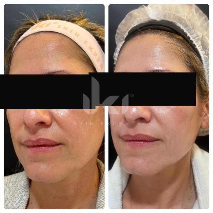 Antes y después de hifu · flacidez en IKI Skin Experts, caso 6, identidad protegida