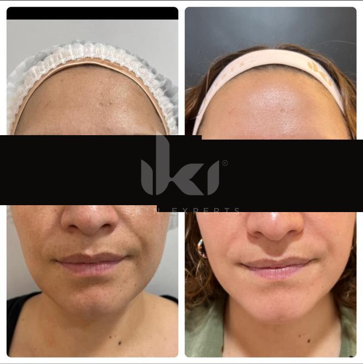 Antes y después de facial médico · hydrafacial en IKI Skin Experts, caso 9, identidad protegida
