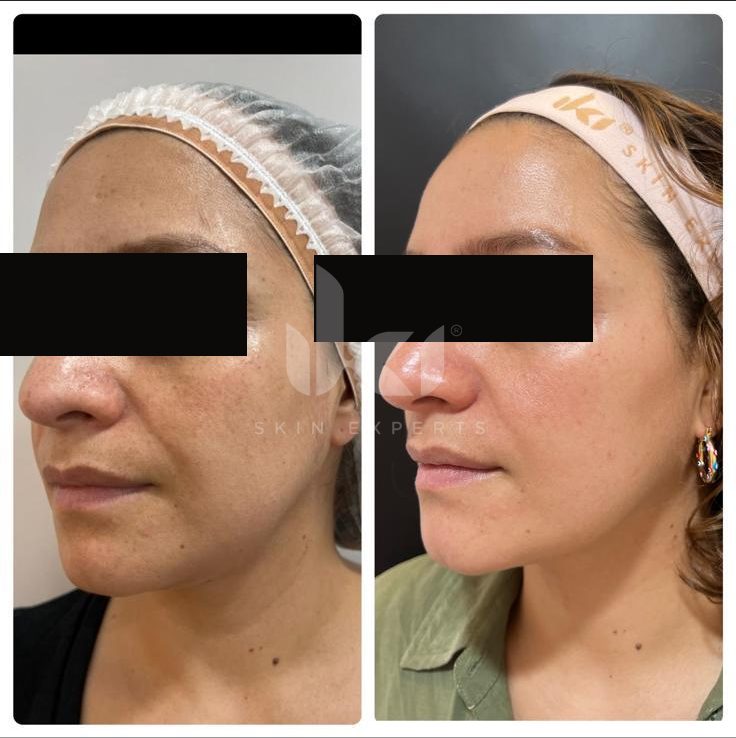 Antes y después de facial médico · hydrafacial en IKI Skin Experts, caso 10, identidad protegida