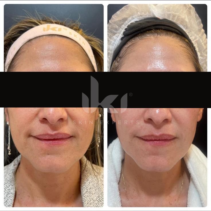 Antes y después de hifu · flacidez en IKI Skin Experts, caso 7, identidad protegida
