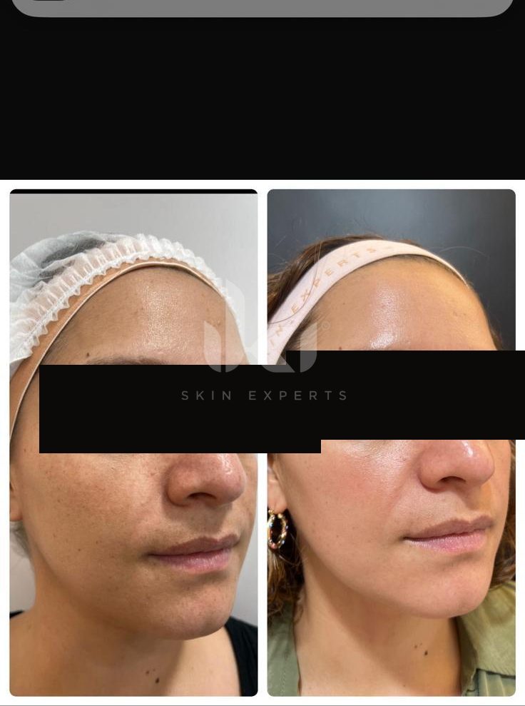 Antes y después de facial médico · hydrafacial en IKI Skin Experts, caso 11, identidad protegida