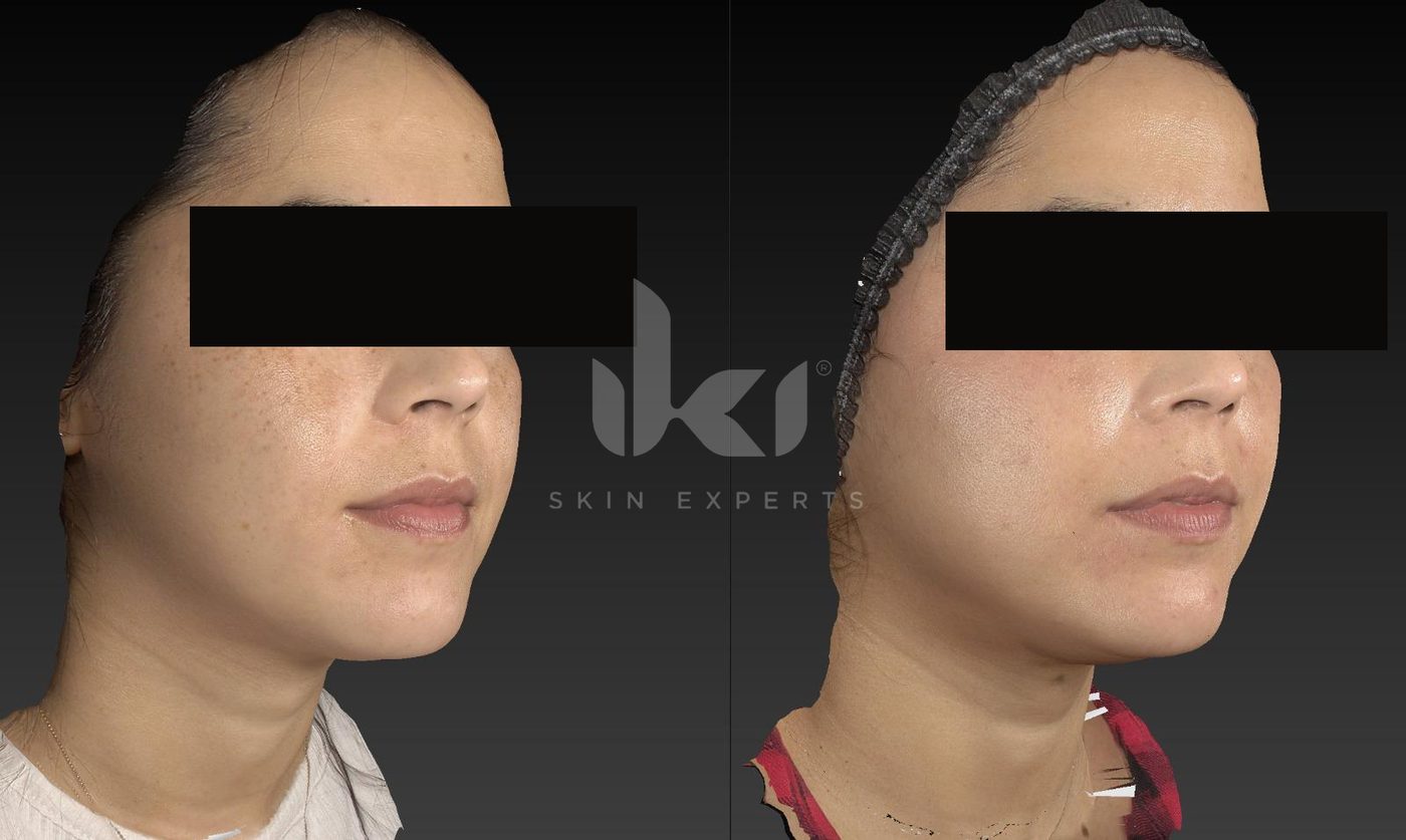 Antes y después de manchas y melasma en IKI Skin Experts, caso 25, identidad protegida