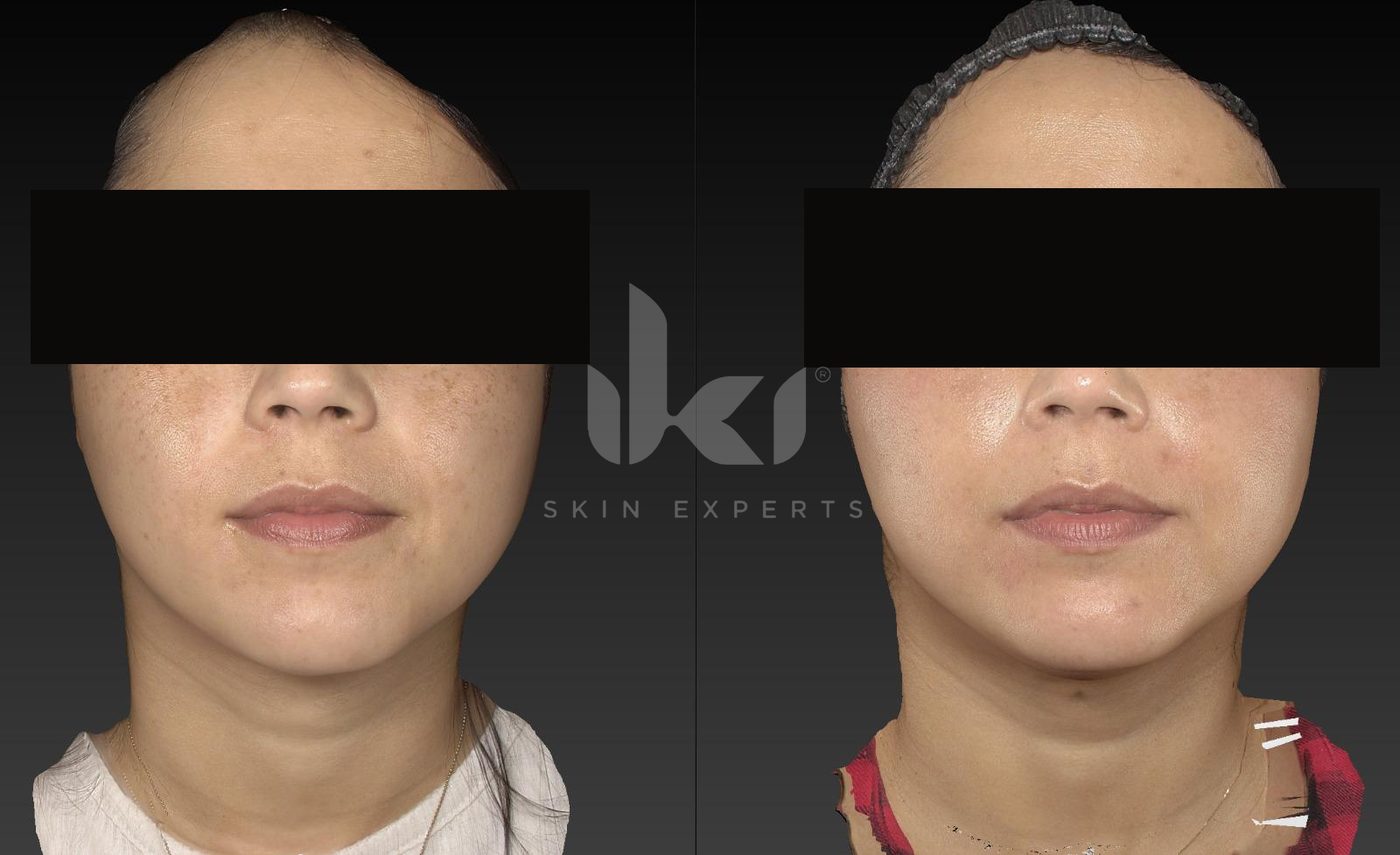 Antes y después de manchas y melasma en IKI Skin Experts, caso 26, identidad protegida
