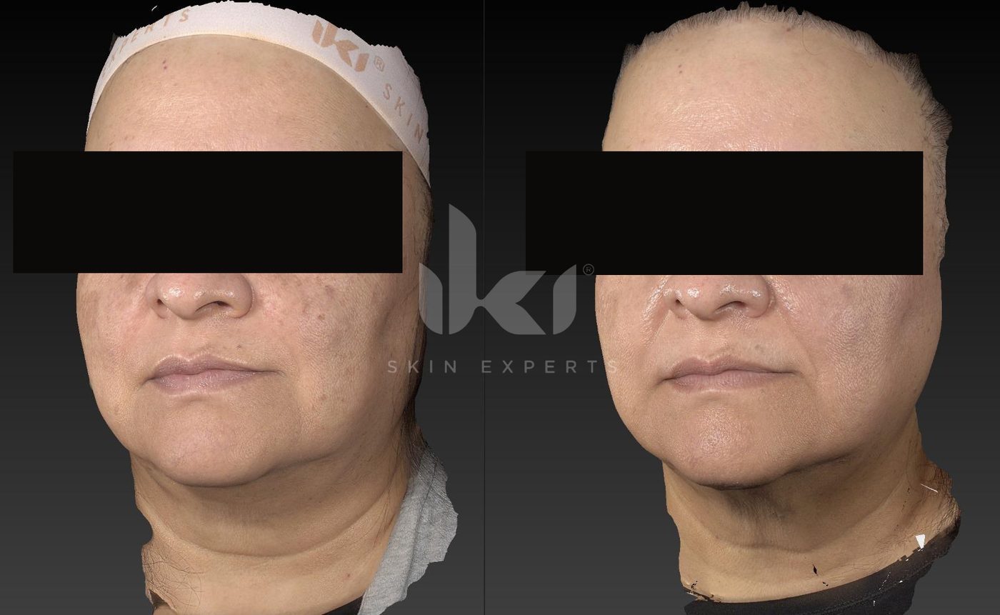 Antes y después de manchas y melasma en IKI Skin Experts, caso 27, identidad protegida