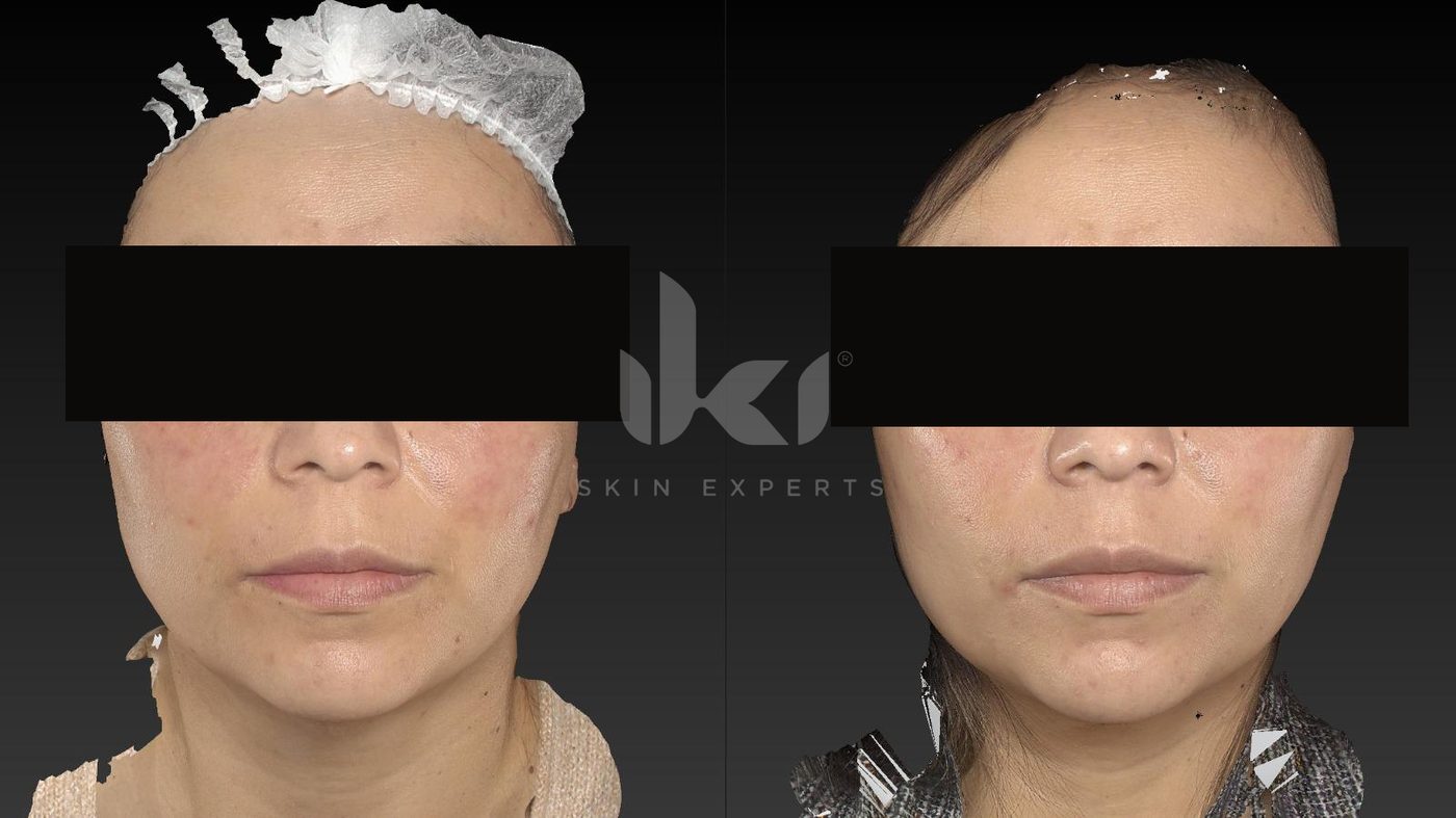 Antes y después de rosácea en IKI Skin Experts, caso 6, identidad protegida