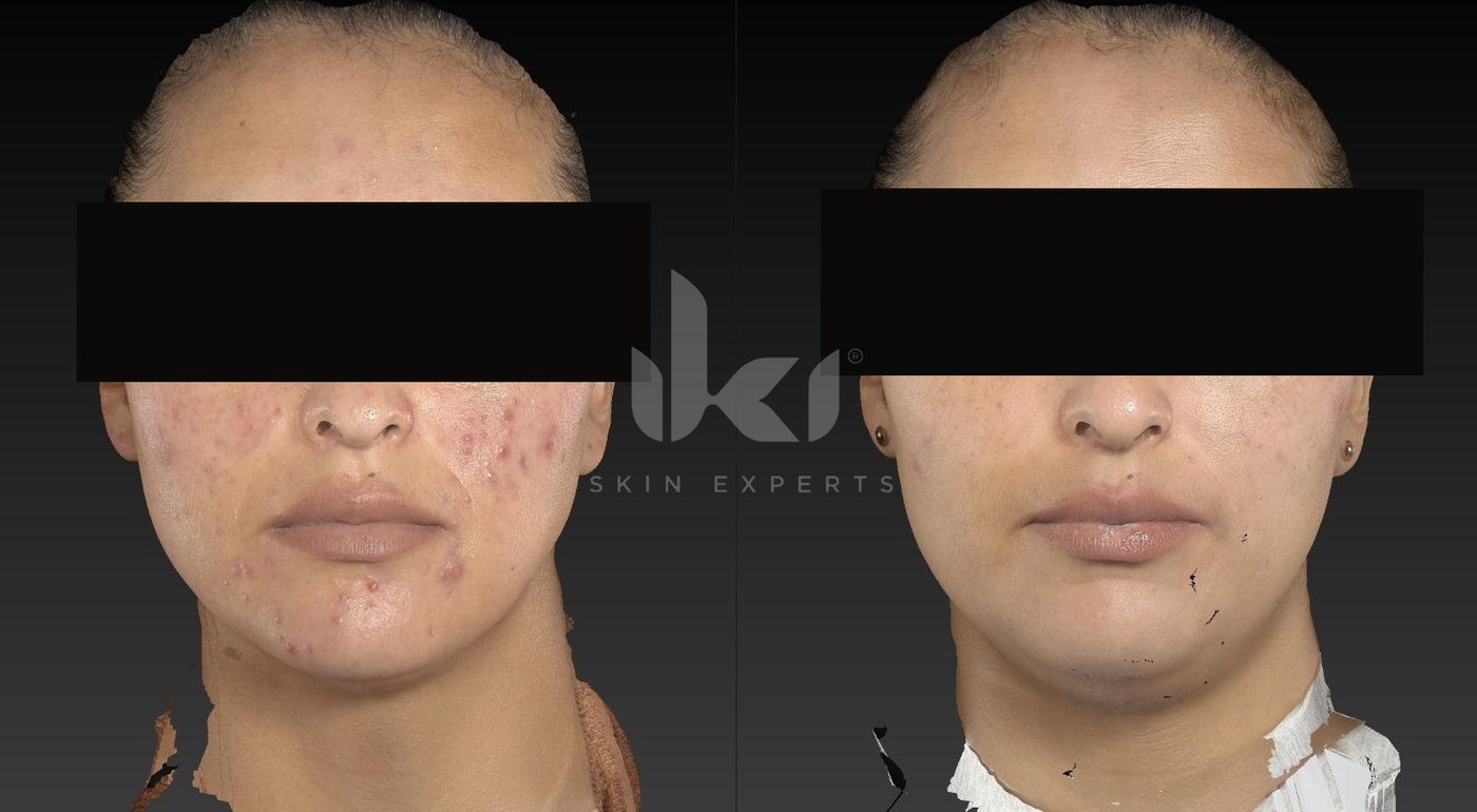 Antes y después de acné en IKI Skin Experts, caso 4, identidad protegida
