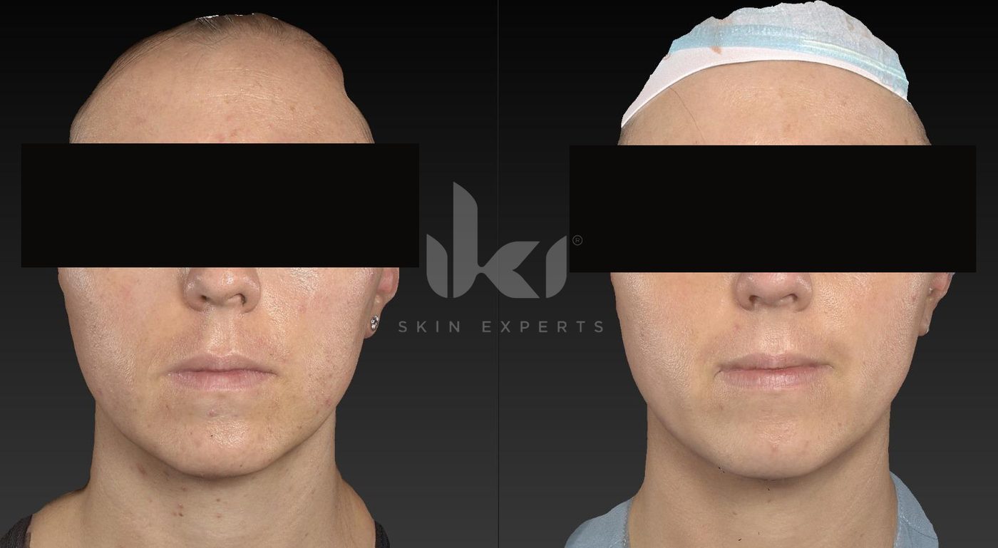 Antes y después de otros casos en IKI Skin Experts, caso 6, identidad protegida