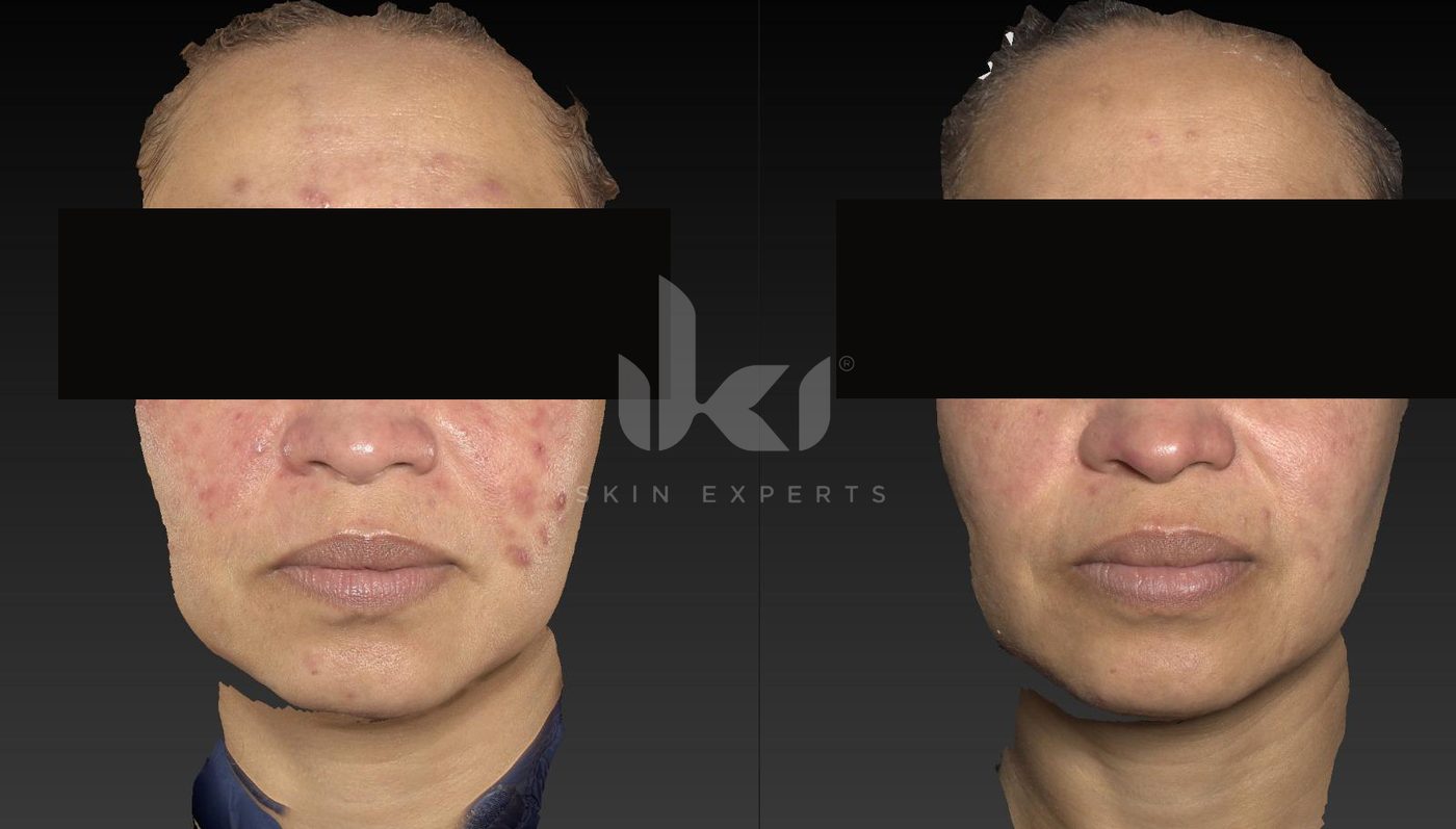 Antes y después de acné en IKI Skin Experts, caso 5, identidad protegida