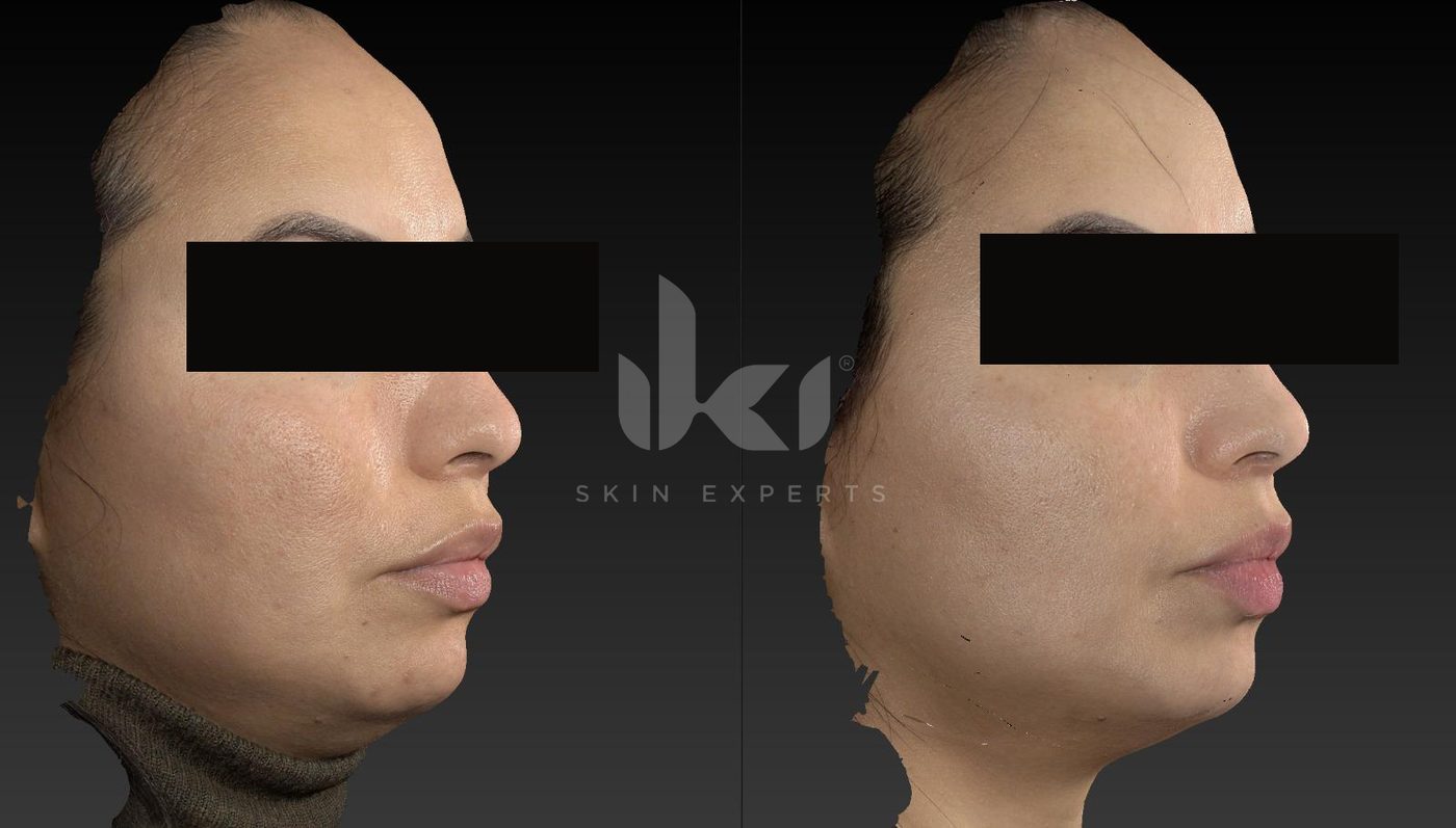 Antes y después de facial médico · hydrafacial en IKI Skin Experts, caso 12, identidad protegida
