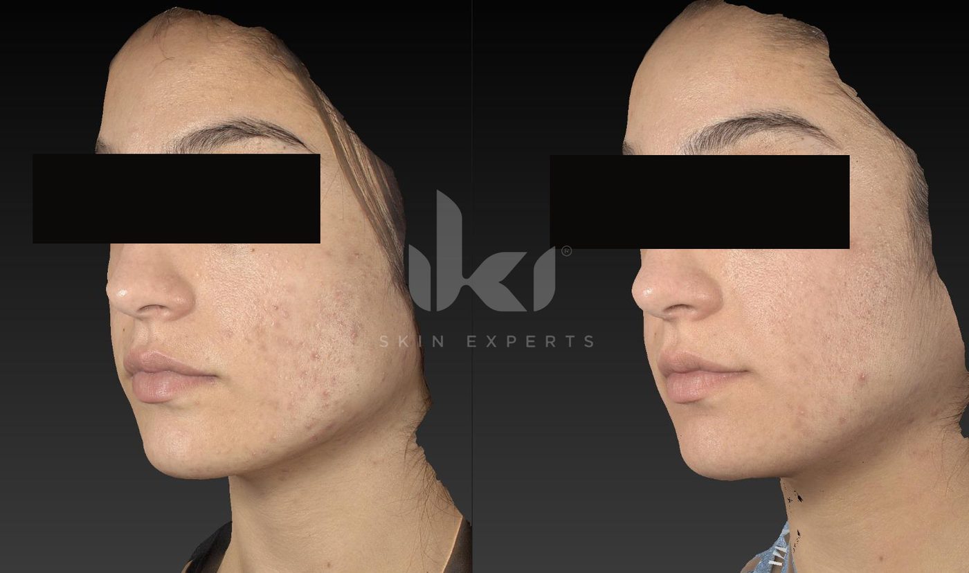 Antes y después de cicatrices en IKI Skin Experts, caso 1, identidad protegida