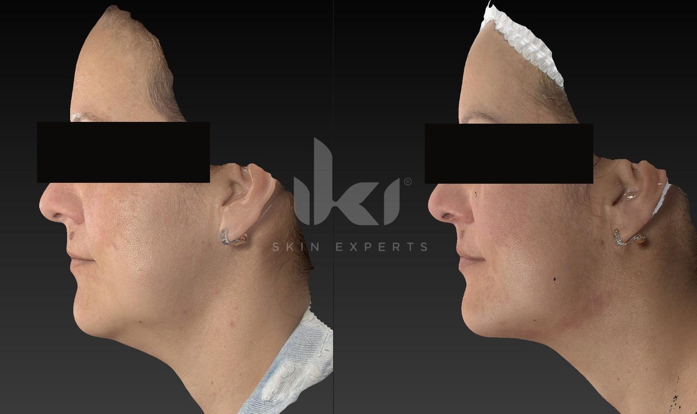 Antes y después de hifu · flacidez en IKI Skin Experts, caso 8, identidad protegida