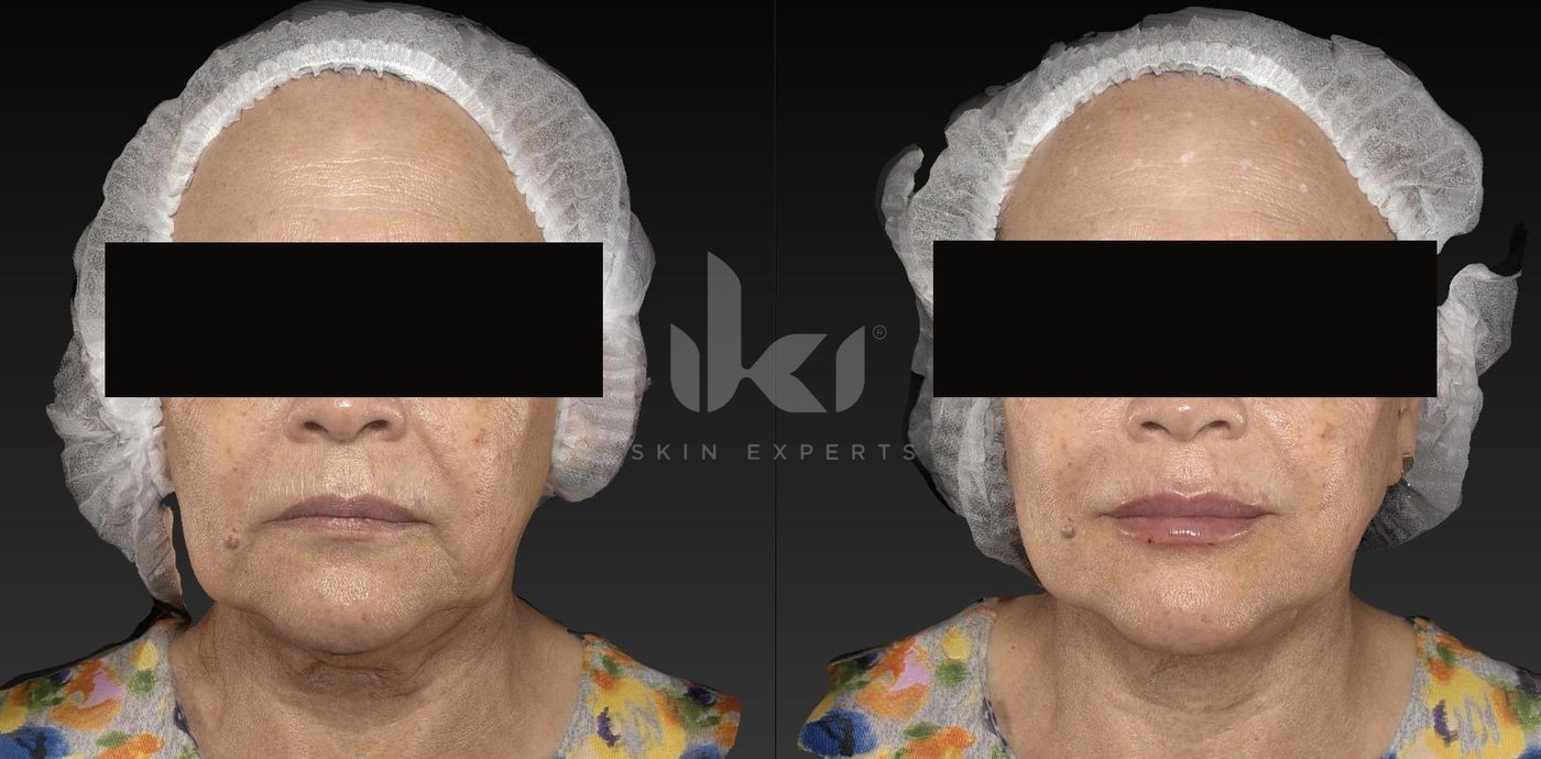 Antes y después de labios en IKI Skin Experts, caso 5, identidad protegida