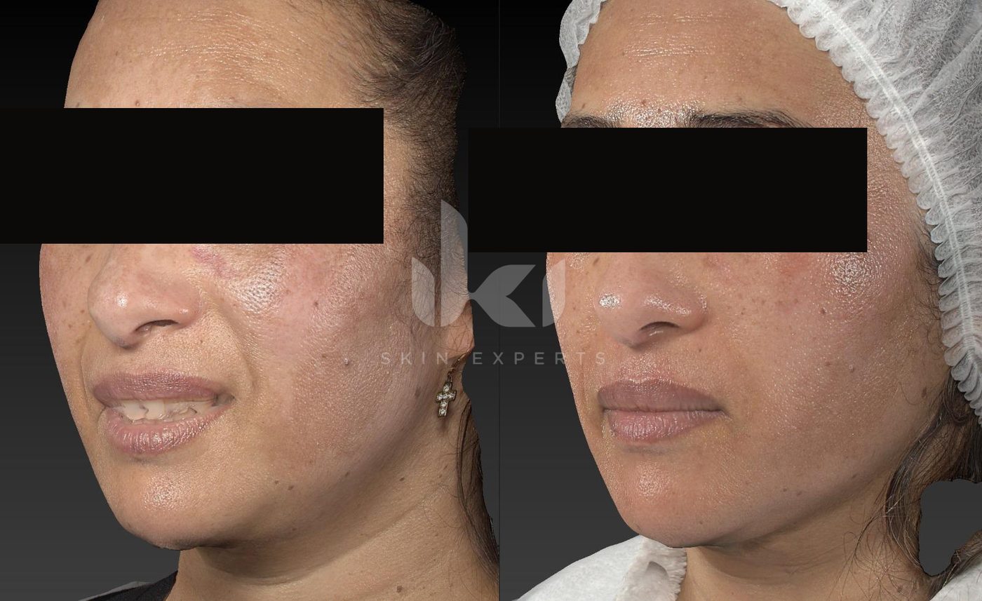Antes y después de manchas y melasma en IKI Skin Experts, caso 28, identidad protegida