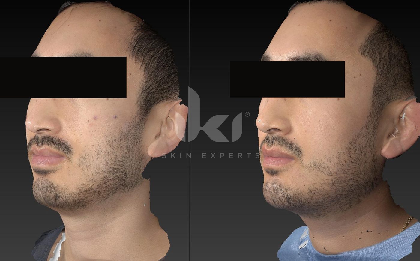 Antes y después de acné en IKI Skin Experts, caso 6, identidad protegida