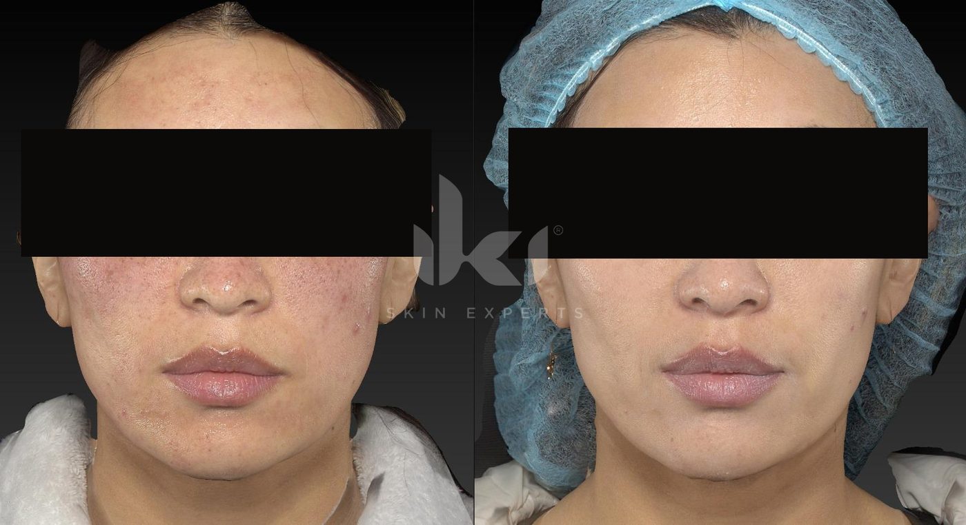 Antes y después de rosácea en IKI Skin Experts, caso 7, identidad protegida