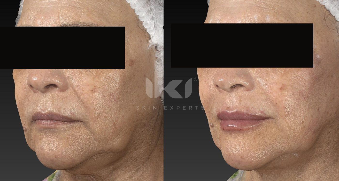 Antes y después de labios en IKI Skin Experts, caso 6, identidad protegida