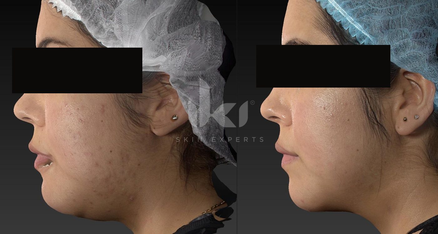 Antes y después de acné en IKI Skin Experts, caso 8, identidad protegida