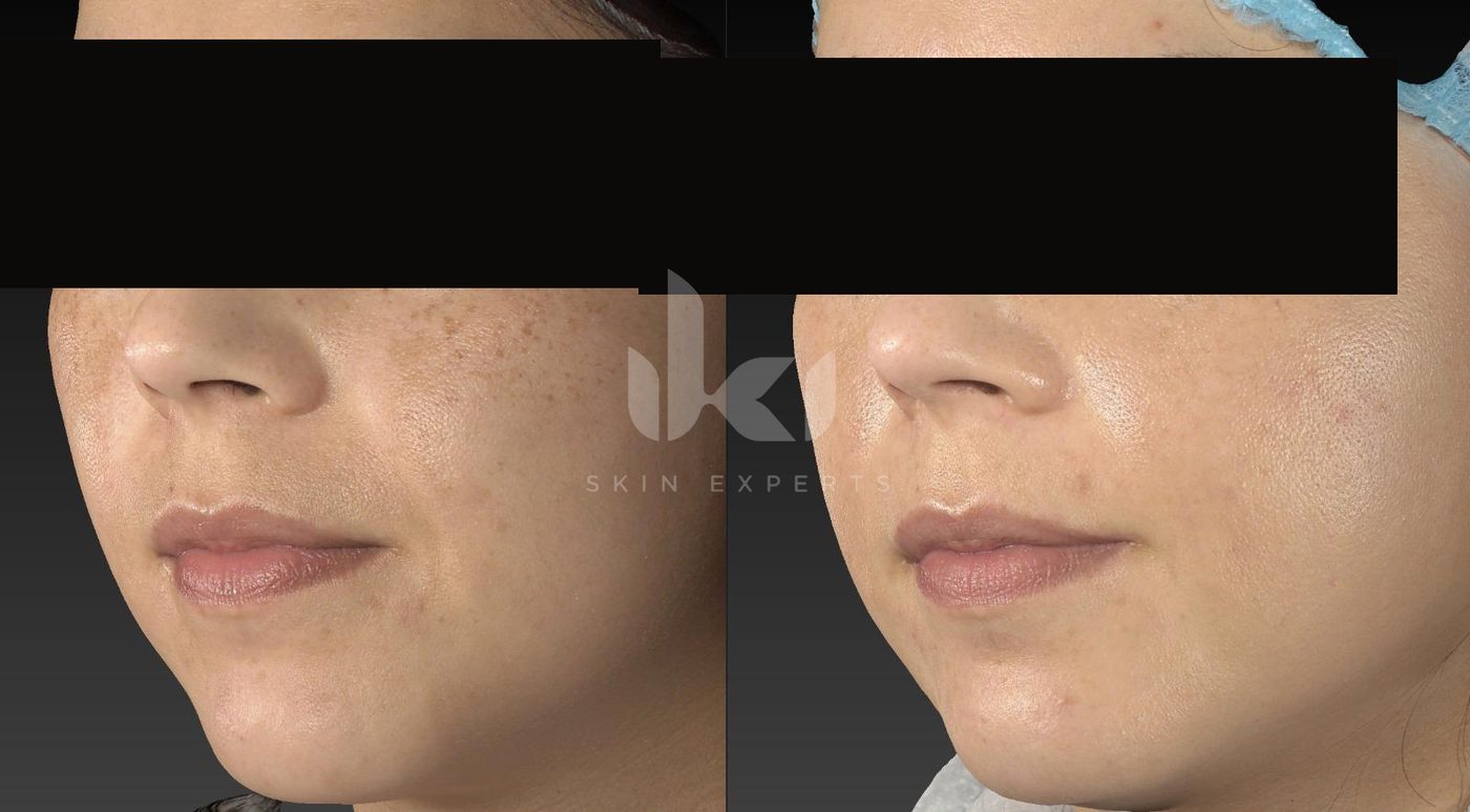 Antes y después de manchas y melasma en IKI Skin Experts, caso 29, identidad protegida