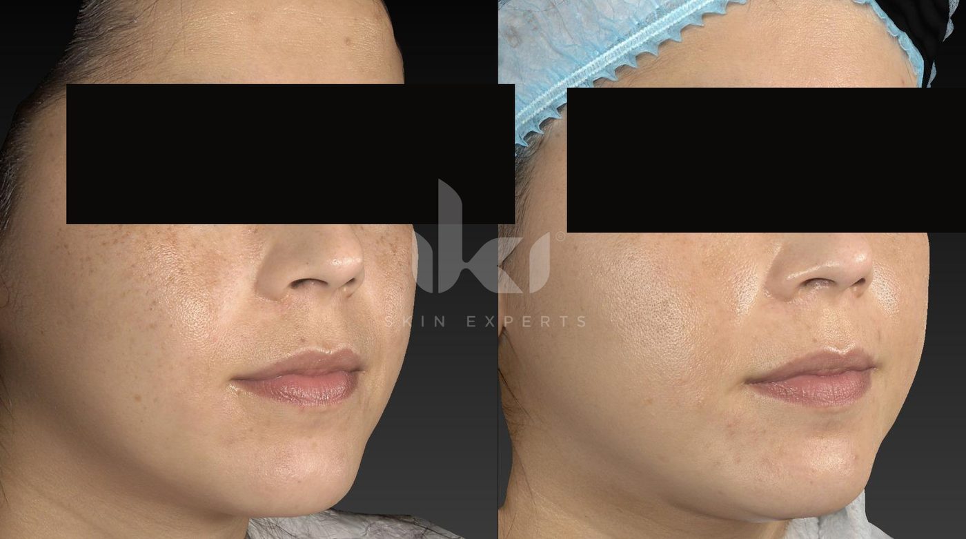 Antes y después de manchas y melasma en IKI Skin Experts, caso 30, identidad protegida