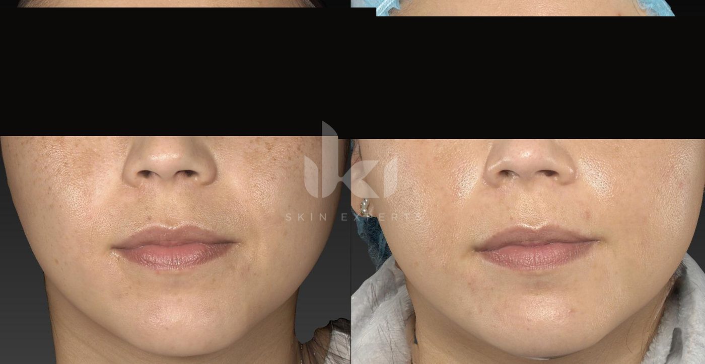 Antes y después de manchas y melasma en IKI Skin Experts, caso 31, identidad protegida