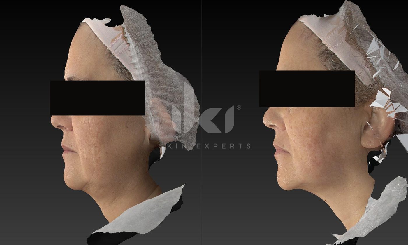 Antes y después de hifu · flacidez en IKI Skin Experts, caso 9, identidad protegida
