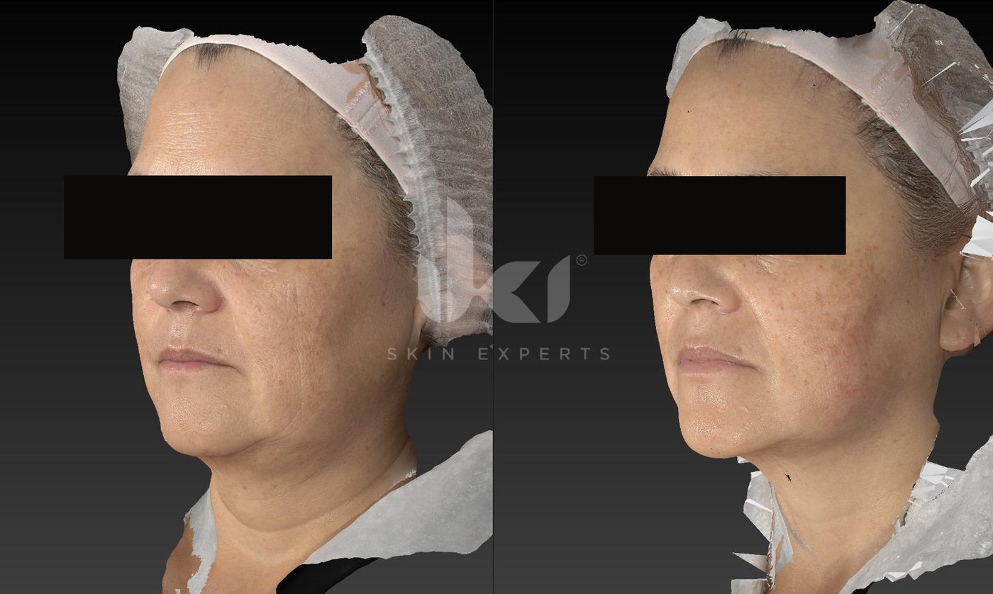 Antes y después de hifu · flacidez en IKI Skin Experts, caso 10, identidad protegida