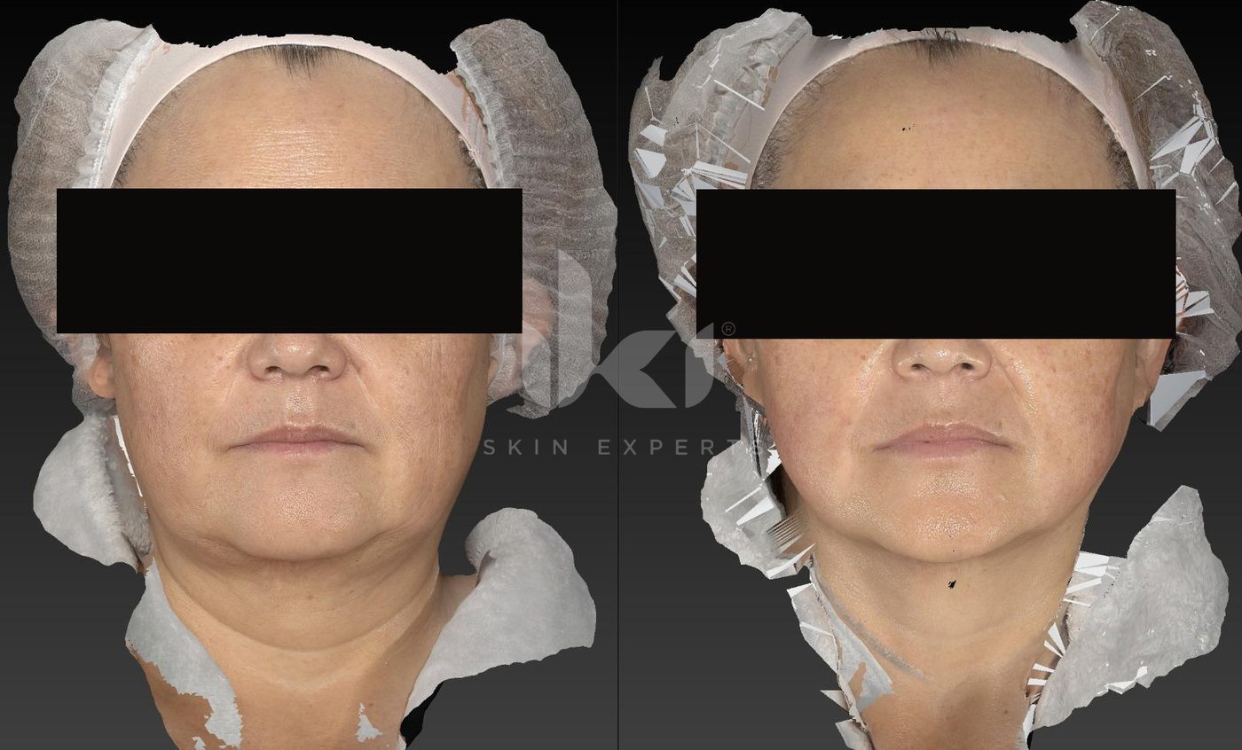 Antes y después de hifu · flacidez en IKI Skin Experts, caso 11, identidad protegida