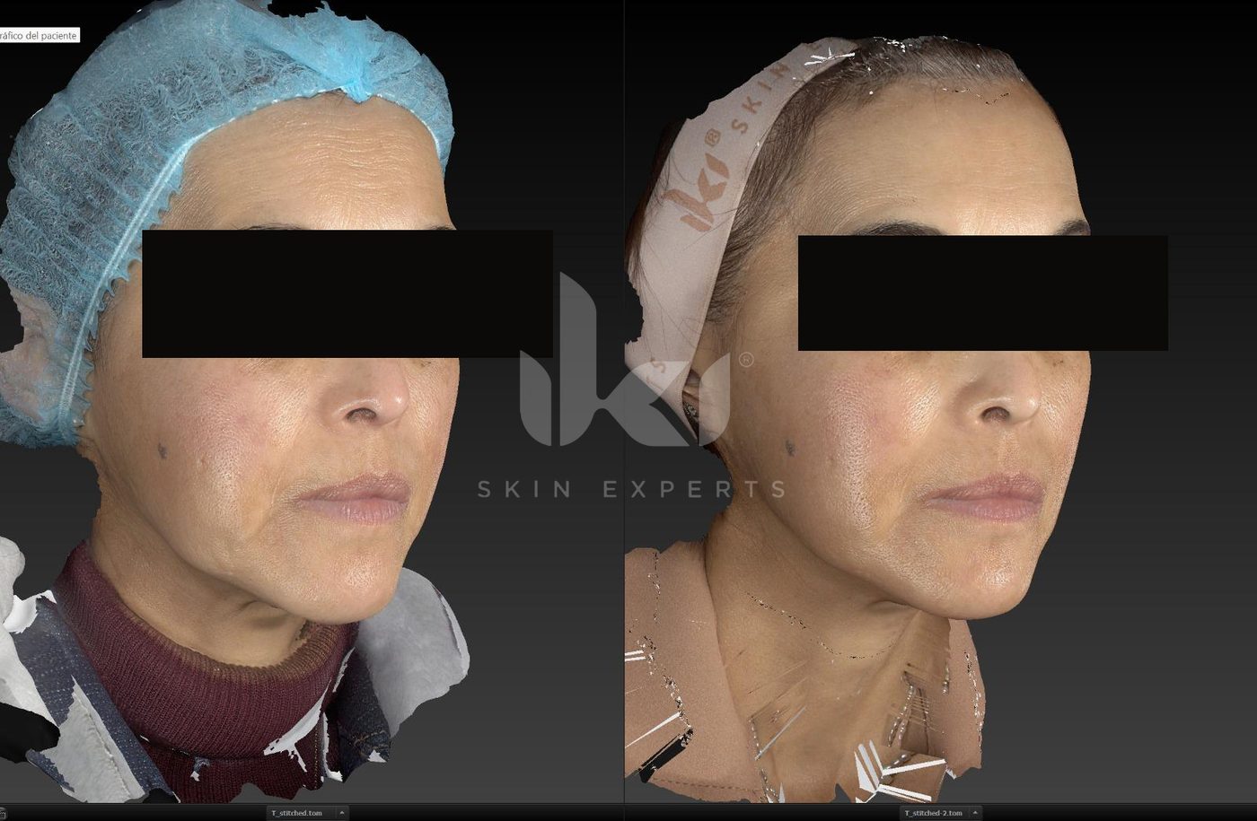Antes y después de hifu · flacidez en IKI Skin Experts, caso 12, identidad protegida
