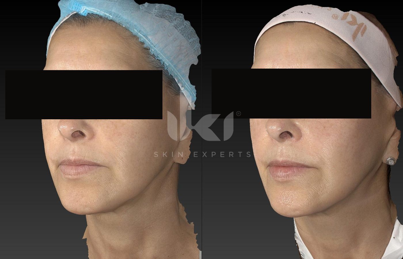 Antes y después de manchas y melasma en IKI Skin Experts, caso 32, identidad protegida
