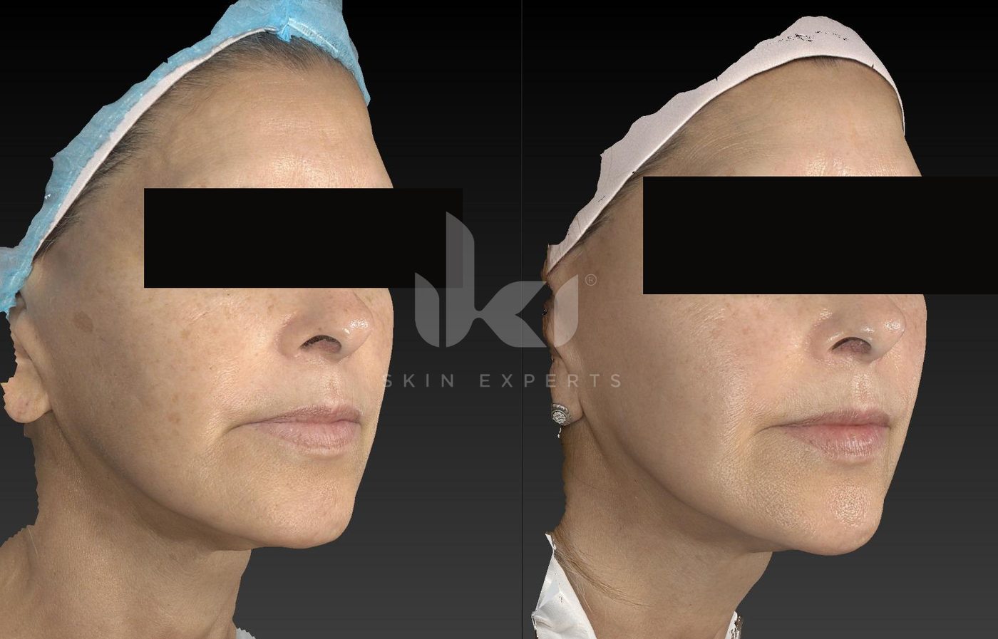 Antes y después de manchas y melasma en IKI Skin Experts, caso 33, identidad protegida