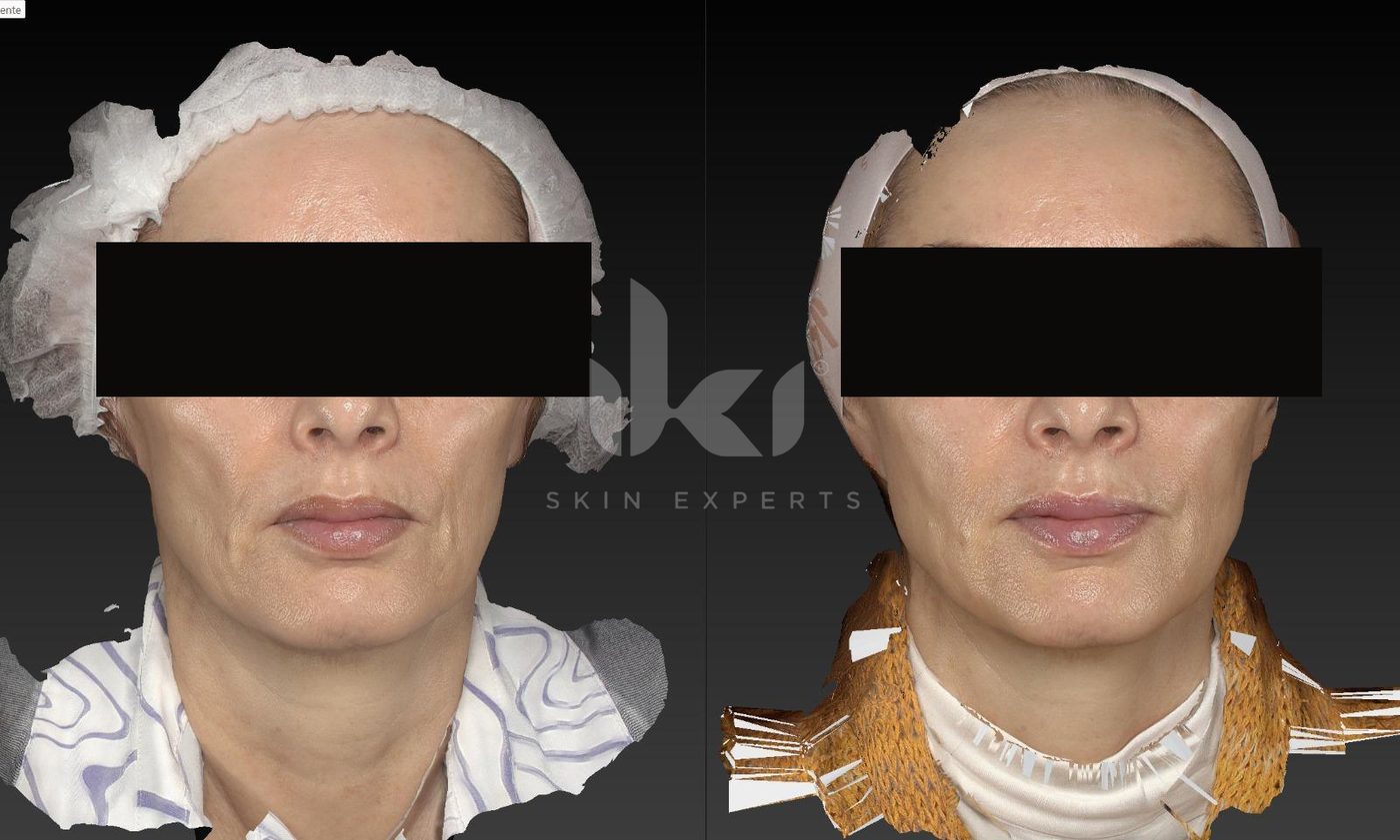 Antes y después de hifu · flacidez en IKI Skin Experts, caso 13, identidad protegida
