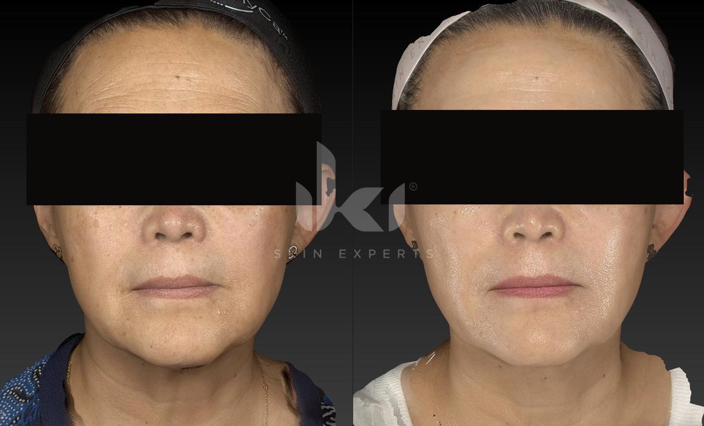 Antes y después de manchas y melasma en IKI Skin Experts, caso 34, identidad protegida