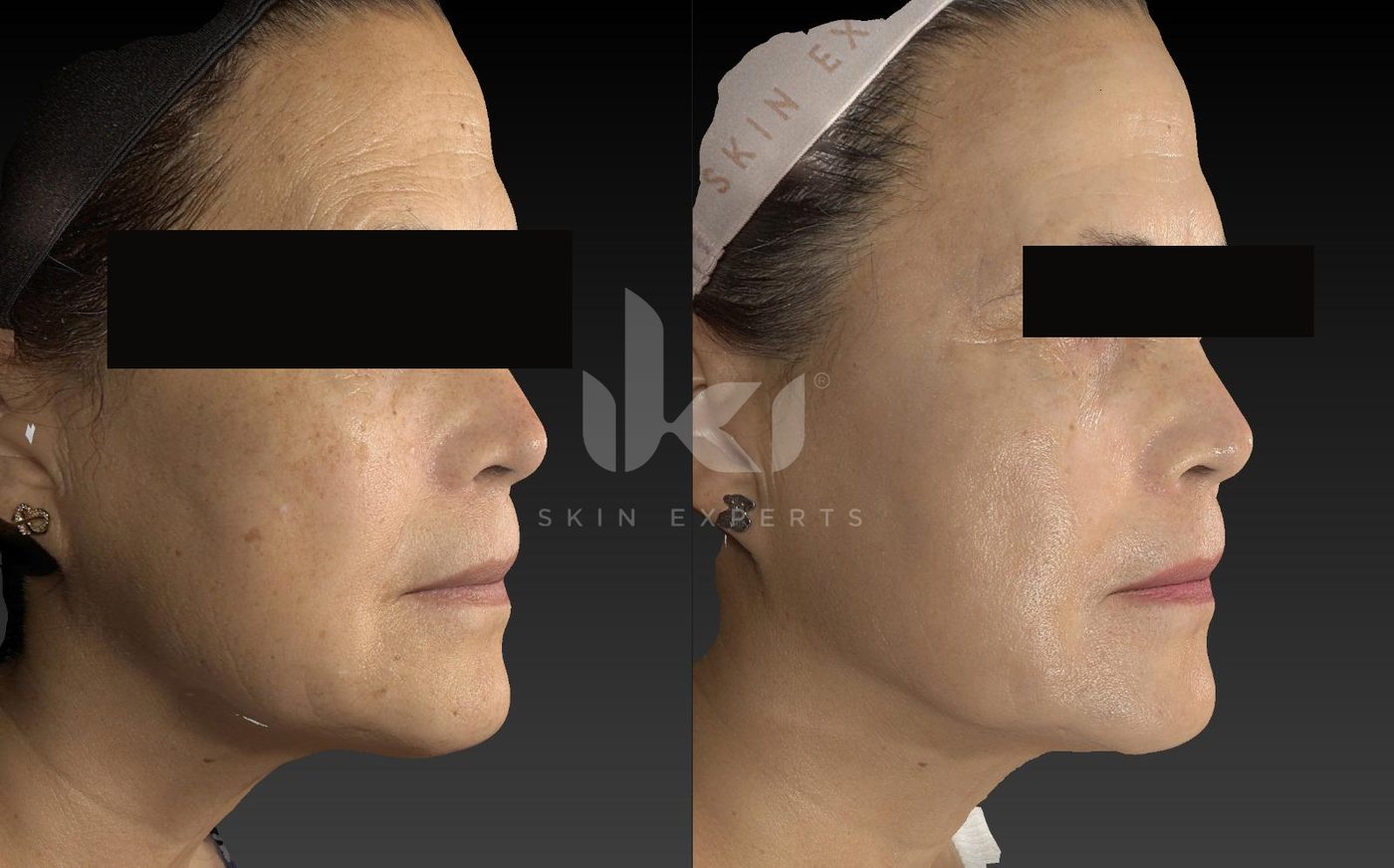 Antes y después de manchas y melasma en IKI Skin Experts, caso 35, identidad protegida