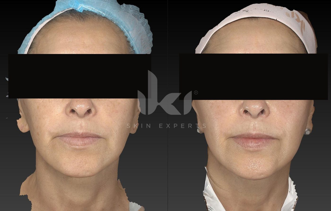 Antes y después de manchas y melasma en IKI Skin Experts, caso 36, identidad protegida