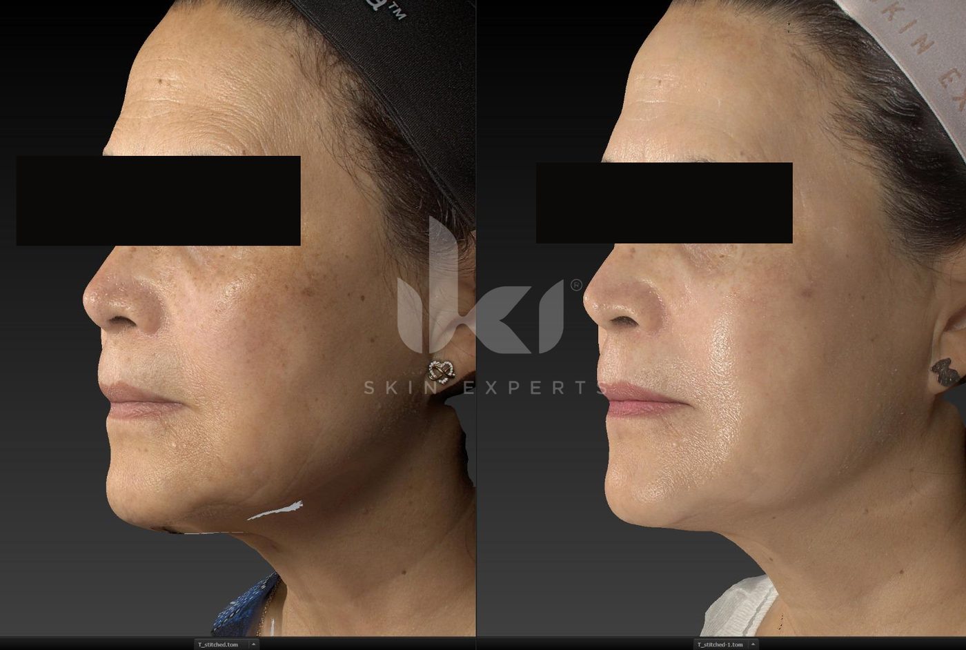 Antes y después de manchas y melasma en IKI Skin Experts, caso 37, identidad protegida