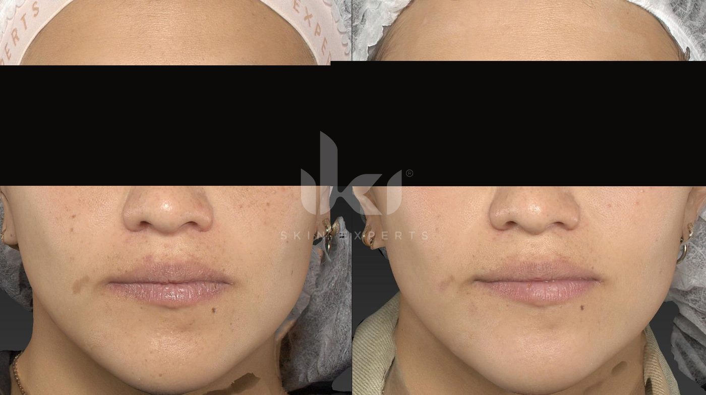 Antes y después de manchas y melasma en IKI Skin Experts, caso 38, identidad protegida