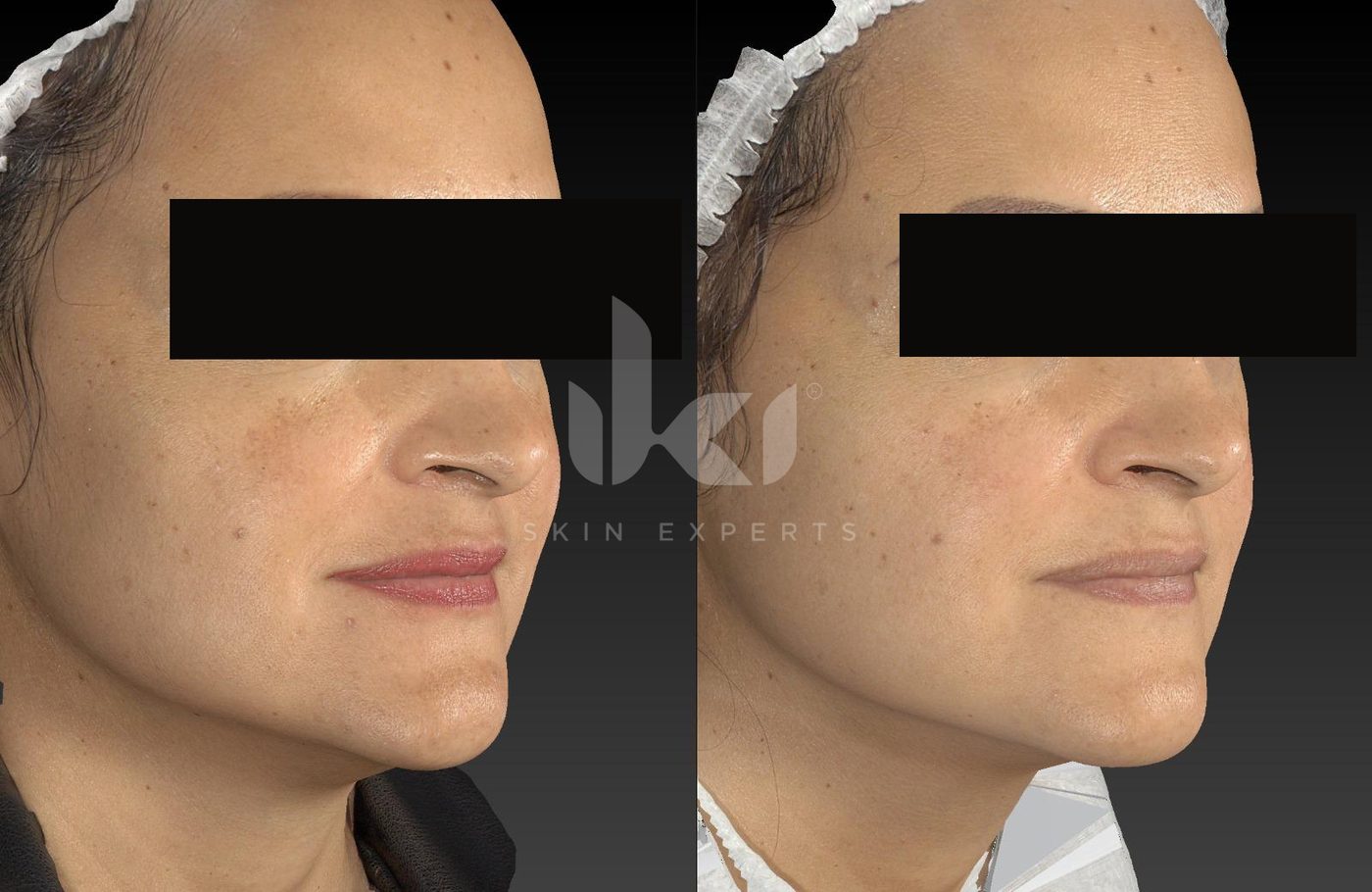 Antes y después de manchas y melasma en IKI Skin Experts, caso 39, identidad protegida