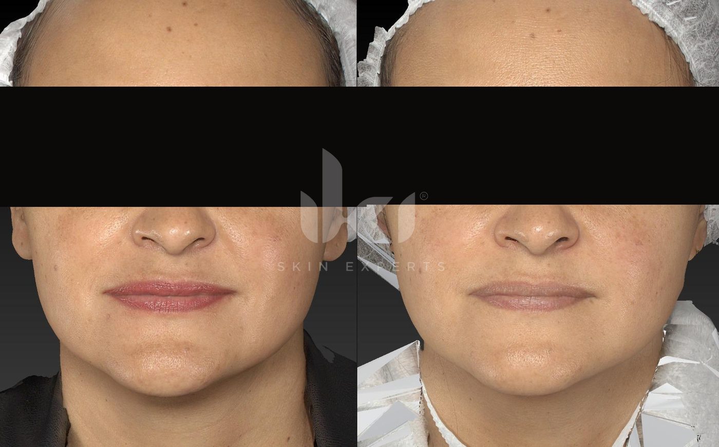 Antes y después de manchas y melasma en IKI Skin Experts, caso 40, identidad protegida