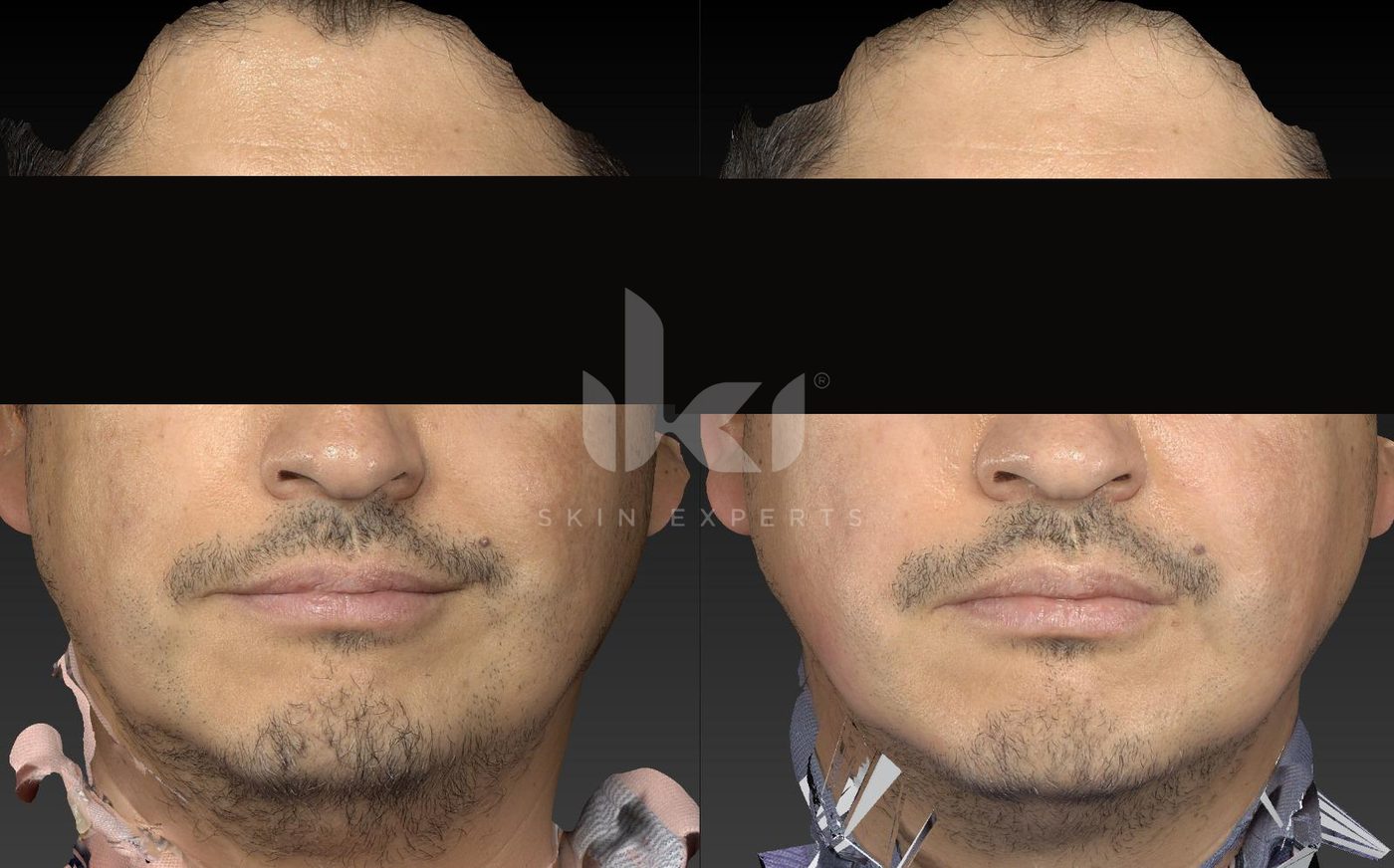 Antes y después de otros casos en IKI Skin Experts, caso 7, identidad protegida