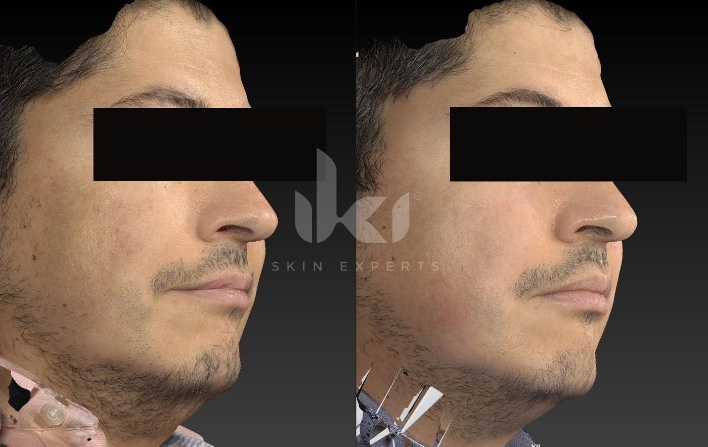 Antes y después de otros casos en IKI Skin Experts, caso 8, identidad protegida