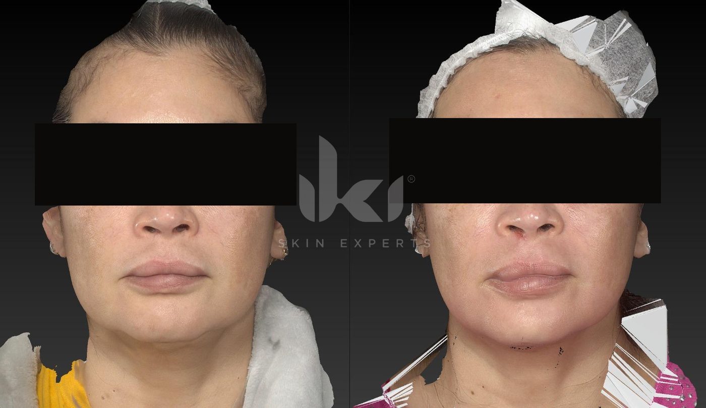 Antes y después de manchas y melasma en IKI Skin Experts, caso 41, identidad protegida