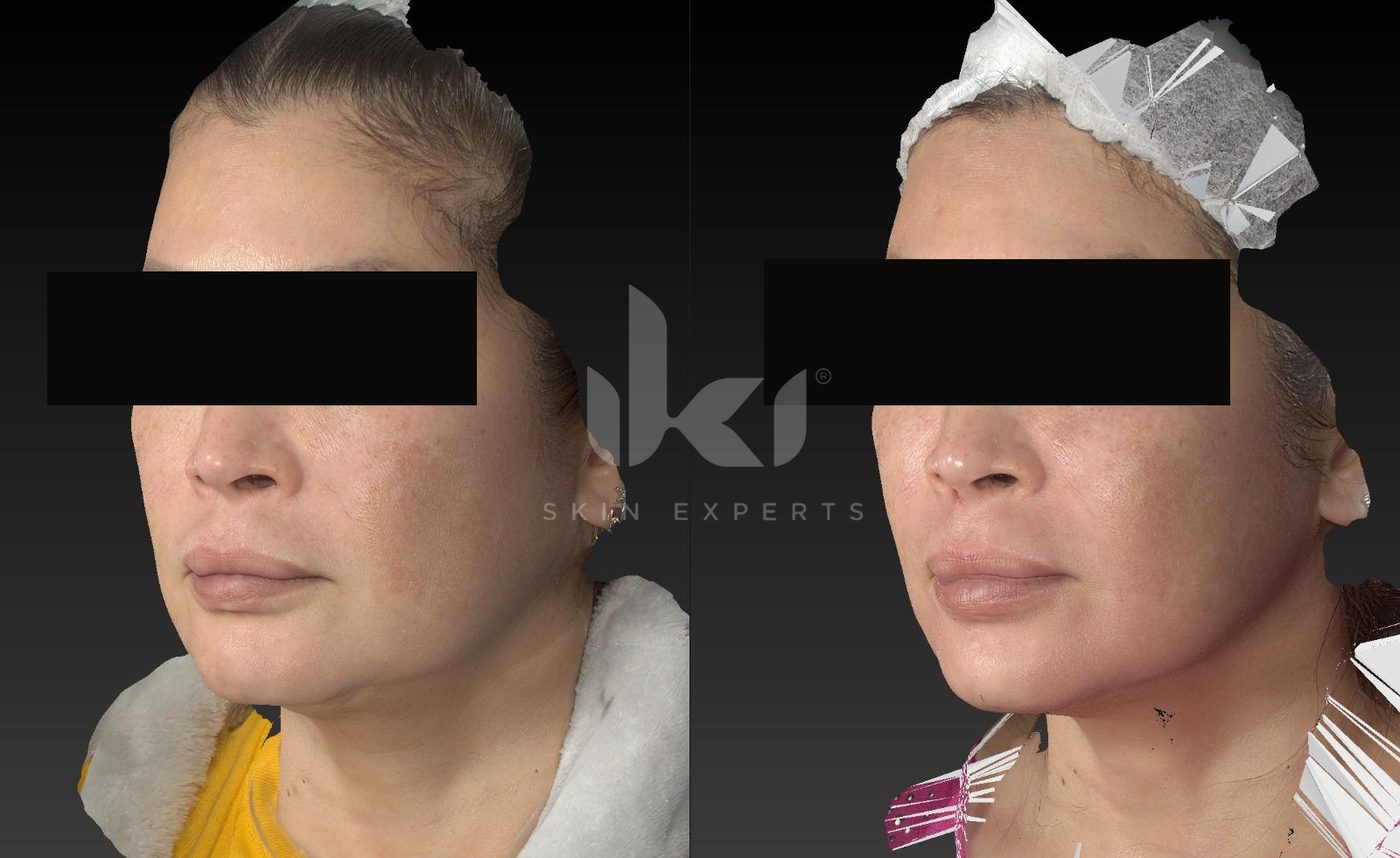Antes y después de manchas y melasma en IKI Skin Experts, caso 42, identidad protegida