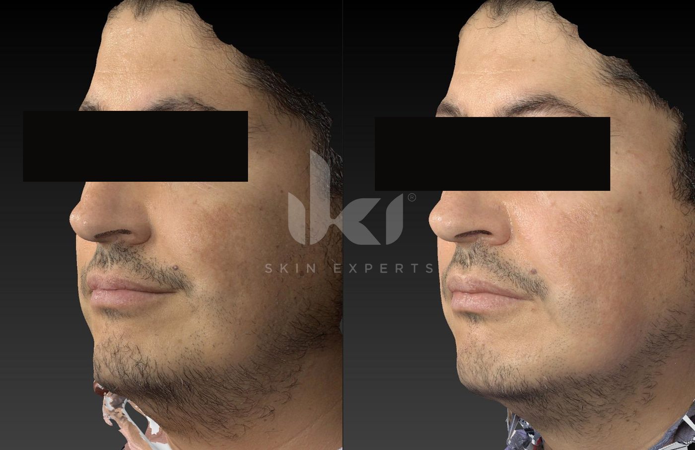Antes y después de otros casos en IKI Skin Experts, caso 9, identidad protegida