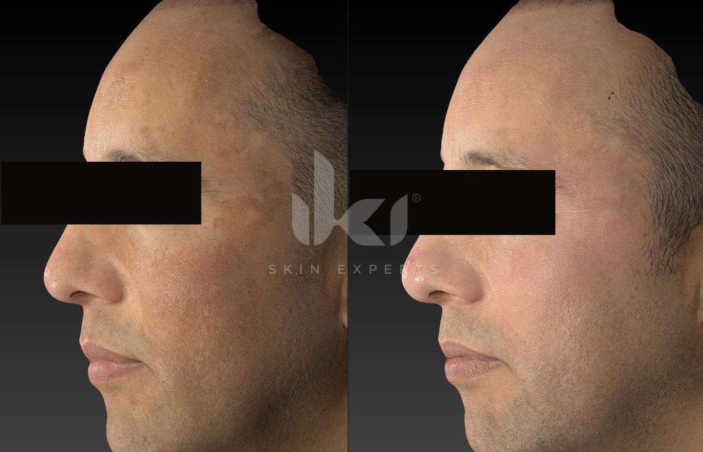 Antes y después de manchas y melasma en IKI Skin Experts, caso 43, identidad protegida