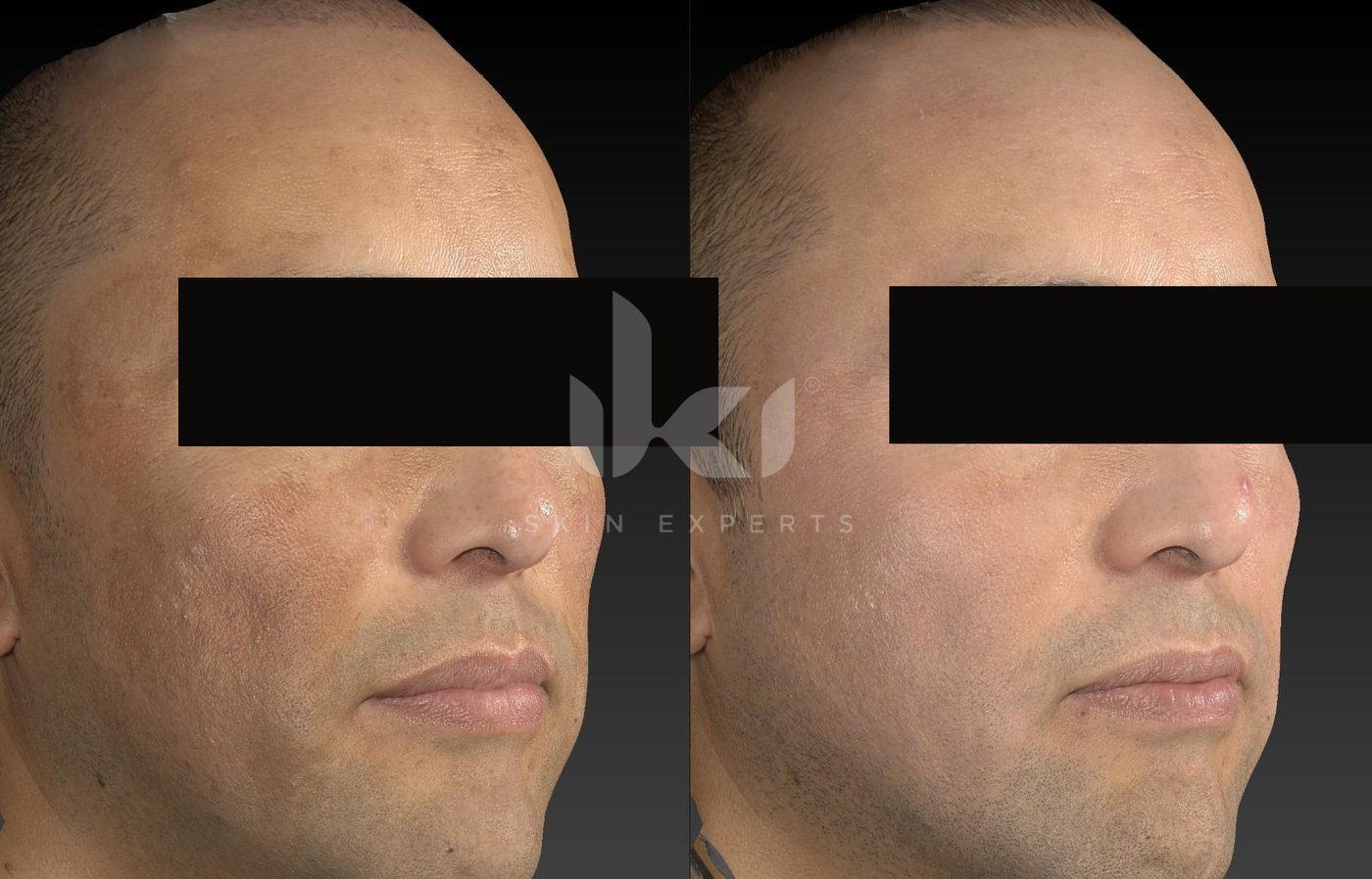 Antes y después de manchas y melasma en IKI Skin Experts, caso 44, identidad protegida