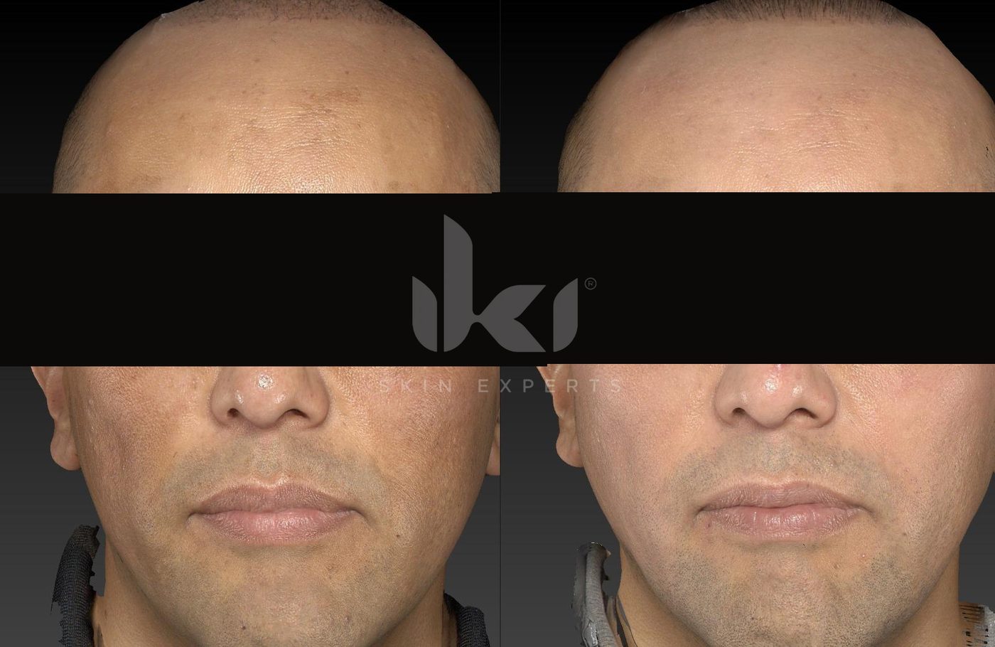 Antes y después de manchas y melasma en IKI Skin Experts, caso 45, identidad protegida